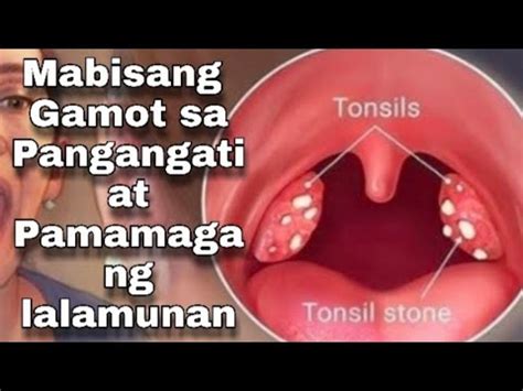 gamot sa tonsil|Pamamaga ng Tonsil (Tonsillitis) .